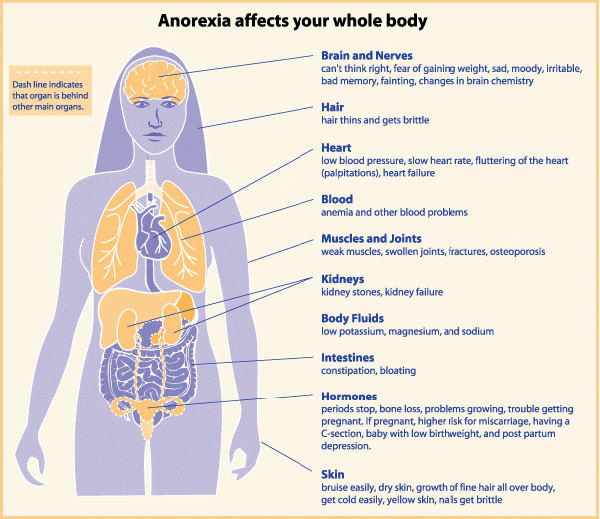 Anorexia