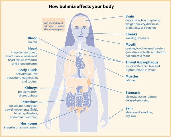 Bulimia